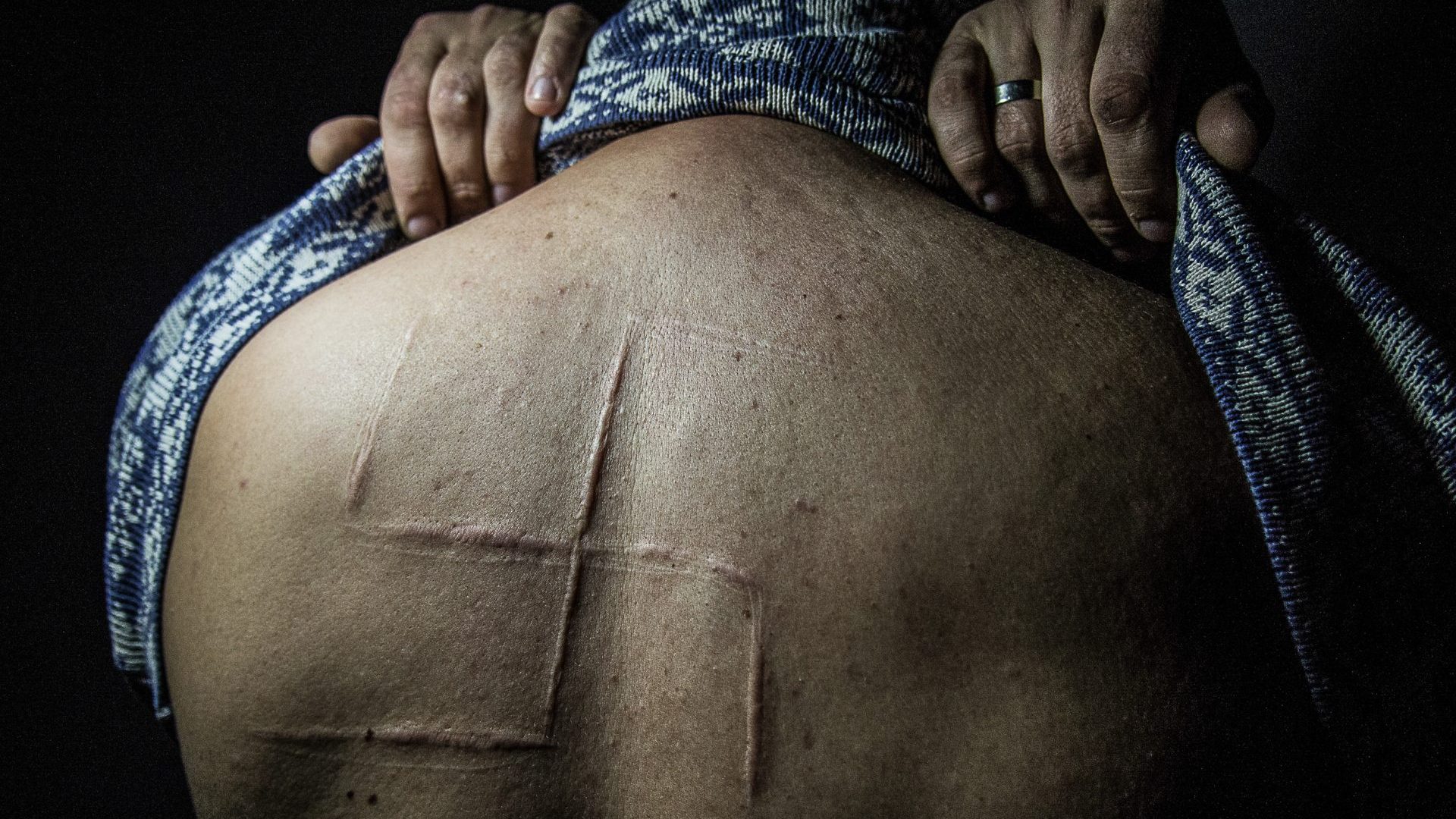 Bogdan was a civilian resident of Donetsk who was taken from his workplace by masked men after he wrote a post opposing the so-called referendum. He was held in the basement of an occupied SBU building, he spent 10 hours in captivity, tortured and beaten, and his captors removed two of his fingernails and engraved the swastika on his back. They referred to him as a “Nazi”. Due to the scar, they did not intend to let him go alive. His relatives managed to rescue him after 10 hours of torture. All images: Zoya Shu