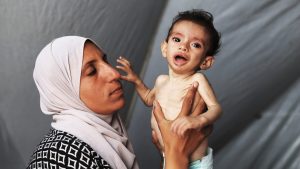 Zakariya al-Majdoub, an 11-month-old baby born in Khan Yunis during Israeli attacks on Gaza, faces life-threatening malnutrition in Gaza. Photo: Khames Alrefi/Anadolu via Getty Images